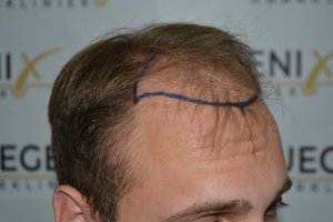 Conservative-yet-Youthfull-Hairline-Transplant-Blond-Hair-10