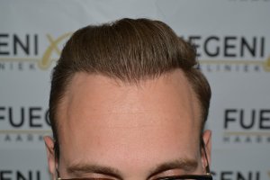Conservative-yet-Youthfull-Hairline-Transplant-Blond-Hair-18