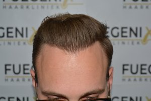 Conservative-yet-Youthfull-Hairline-Transplant-Blond-Hair-19