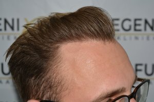 Conservative-yet-Youthfull-Hairline-Transplant-Blond-Hair-23