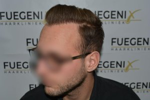 Conservative-yet-Youthfull-Hairline-Transplant-Blond-Hair-28