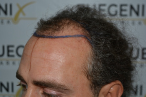 Dr.-Munib-Ahmad-2645g-Curly-Hairline-9