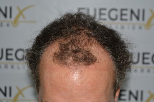 Dr.-Munib-Ahmad-2645g-Curly-Hairline-5