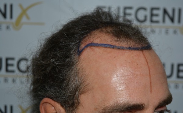Dr.-Munib-Ahmad-2645g-Curly-Hairline-8