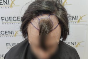 From-Failed-Hair-Transplant-To-Shah-Rukh-Khan-16