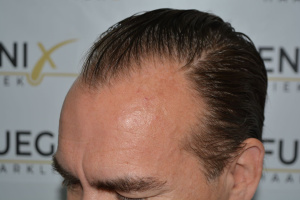 Hairline-Artistry-At-Its-Best-10