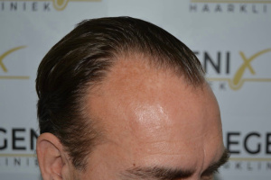 Hairline-Artistry-At-Its-Best-11