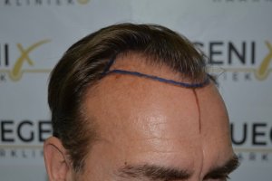 Hairline-Artistry-At-Its-Best-20