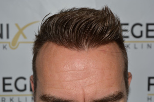 Hairline Artistry At It's Best