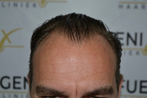 Hairline-Artistry-At-Its-Best-7