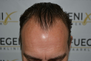 Hairline-Artistry-At-Its-Best-8