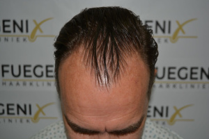 Hairline-Artistry-At-Its-Best-9