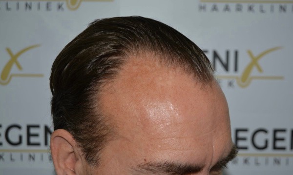 Hairline-Artistry-At-Its-Best-11