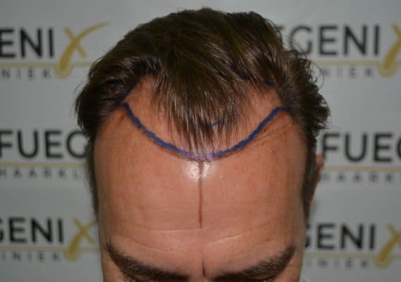 Hairline-Artistry-At-Its-Best-18