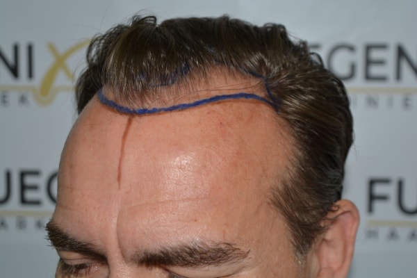 Hairline-Artistry-At-Its-Best-19