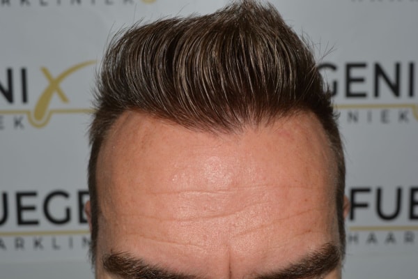 Hairline-Artistry-At-Its-Best-31