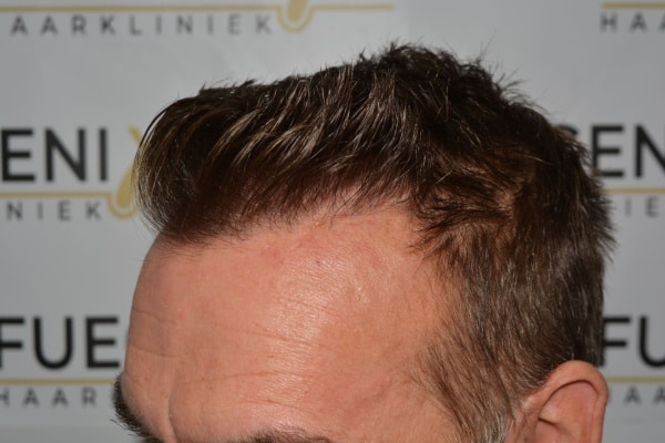 Hairline-Artistry-At-Its-Best-35