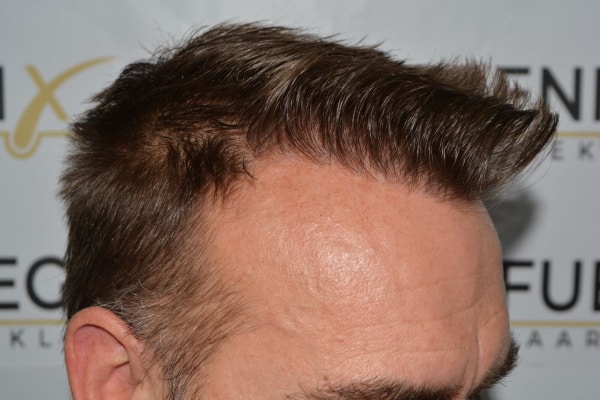 Hairline-Artistry-At-Its-Best-36