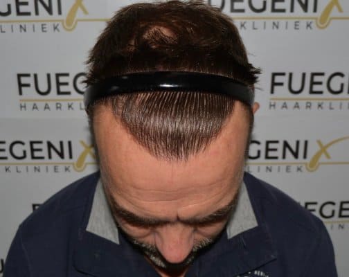 Hairline-Artistry-At-Its-Best-39