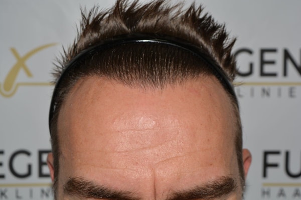 Hairline-Artistry-At-Its-Best-40