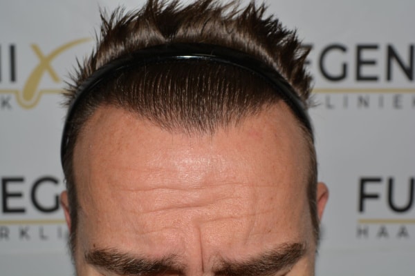 Hairline-Artistry-At-Its-Best-41