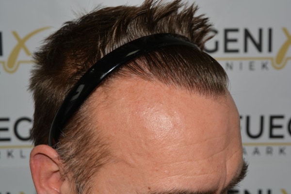 Hairline-Artistry-At-Its-Best-44