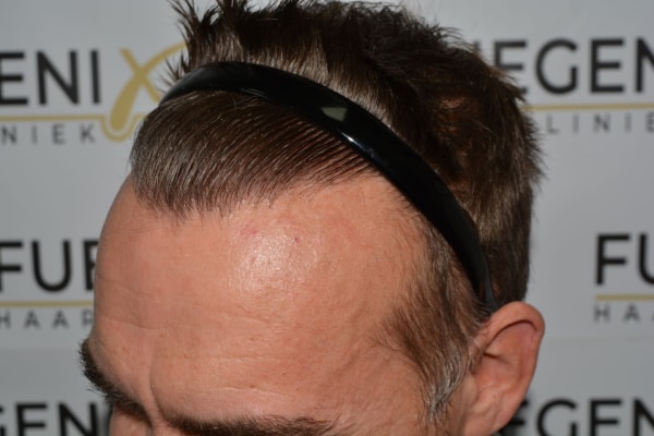 Hairline-Artistry-At-Its-Best-45