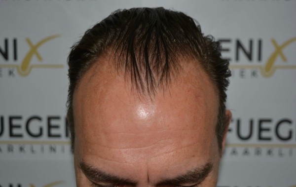 Hairline-Artistry-At-Its-Best-8