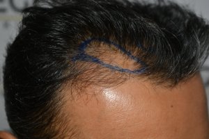 How-To-Cover-One-Corner-Of-Hairline-Midscalp-Crown-In-A-Single-Session-11