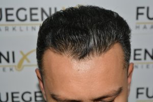 How-To-Cover-One-Corner-Of-Hairline-Midscalp-Crown-In-A-Single-Session-15