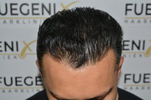 How-To-Cover-One-Corner-Of-Hairline-Midscalp-Crown-In-A-Single-Session-16