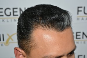 How-To-Cover-One-Corner-Of-Hairline-Midscalp-Crown-In-A-Single-Session-18