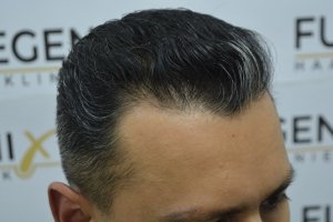 How-To-Cover-One-Corner-Of-Hairline-Midscalp-Crown-In-A-Single-Session-19