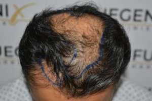 How-To-Cover-One-Corner-Of-Hairline-Midscalp-Crown-In-A-Single-Session-2