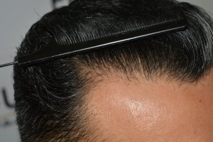 How-To-Cover-One-Corner-Of-Hairline-Midscalp-Crown-In-A-Single-Session-20