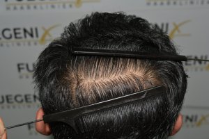 How-To-Cover-One-Corner-Of-Hairline-Midscalp-Crown-In-A-Single-Session-24