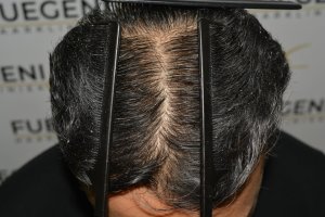 How-To-Cover-One-Corner-Of-Hairline-Midscalp-Crown-In-A-Single-Session-28