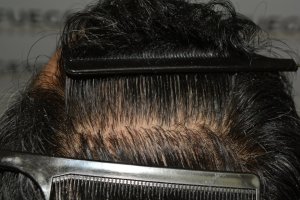 How-To-Cover-One-Corner-Of-Hairline-Midscalp-Crown-In-A-Single-Session-30