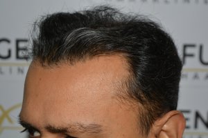 How-To-Cover-One-Corner-Of-Hairline-Midscalp-Crown-In-A-Single-Session-7