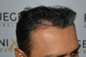 How-To-Cover-One-Corner-Of-Hairline-Midscalp-Crown-In-A-Single-Session-9