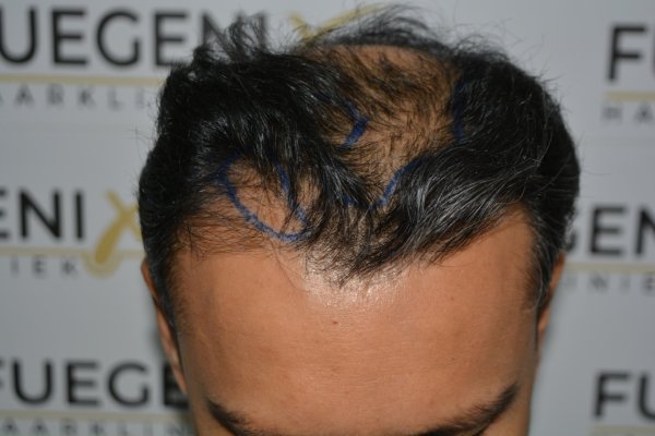 How-To-Cover-One-Corner-Of-Hairline-Midscalp-Crown-In-A-Single-Session-10
