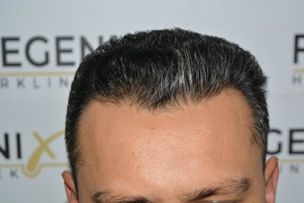 How-To-Cover-One-Corner-Of-Hairline-Midscalp-Crown-In-A-Single-Session-14
