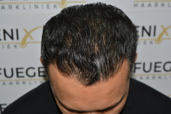How-To-Cover-One-Corner-Of-Hairline-Midscalp-Crown-In-A-Single-Session-17