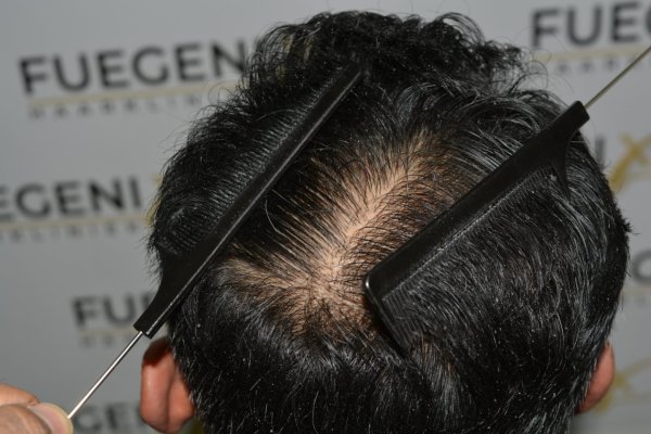 How-To-Cover-One-Corner-Of-Hairline-Midscalp-Crown-In-A-Single-Session-31