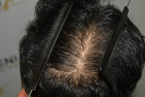 How-To-Cover-One-Corner-Of-Hairline-Midscalp-Crown-In-A-Single-Session-32