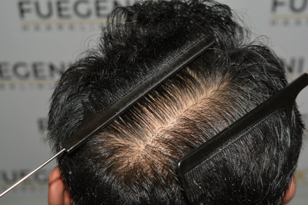 How-To-Cover-One-Corner-Of-Hairline-Midscalp-Crown-In-A-Single-Session-33