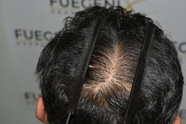 How-To-Cover-One-Corner-Of-Hairline-Midscalp-Crown-In-A-Single-Session-35