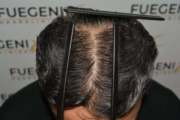 How-To-Cover-One-Corner-Of-Hairline-Midscalp-Crown-In-A-Single-Session-36