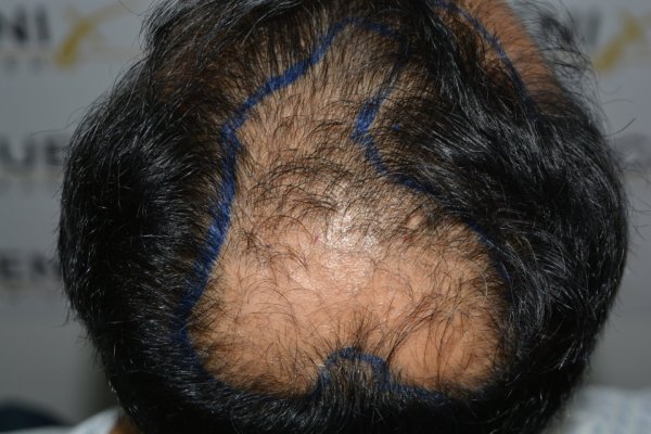 How-To-Cover-One-Corner-Of-Hairline-Midscalp-Crown-In-A-Single-Session-6