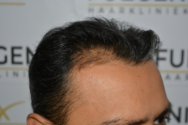 How-To-Cover-One-Corner-Of-Hairline-Midscalp-Crown-In-A-Single-Session-8